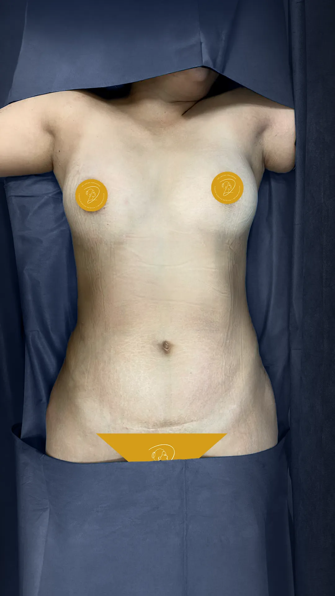 Abdomen: antes