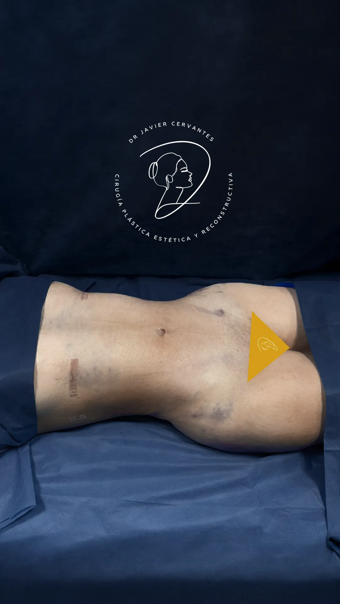 Glúteos y contorno: después
