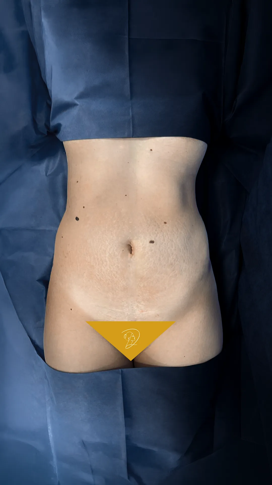 Abdomen: antes