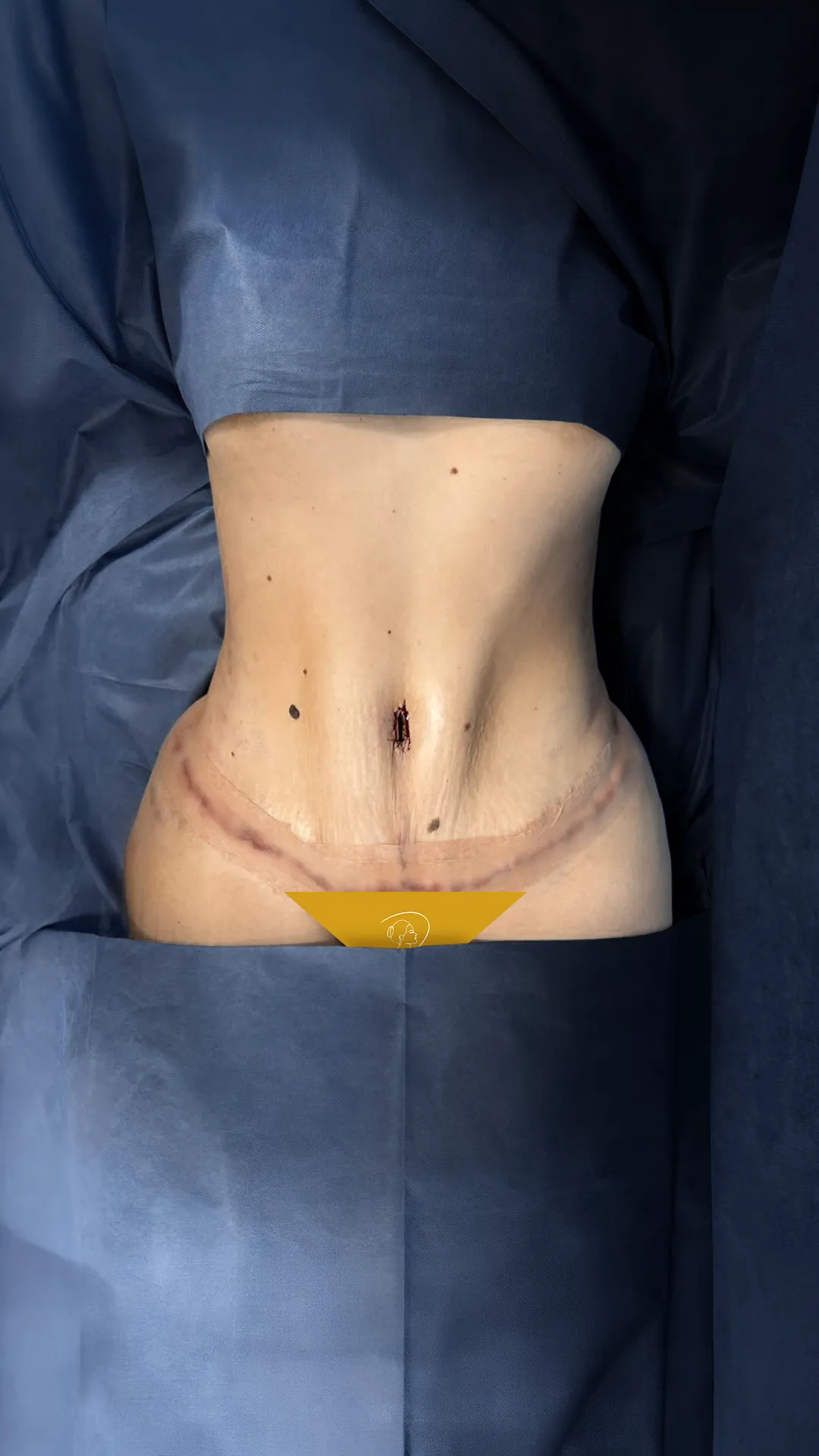 Abdomen: después