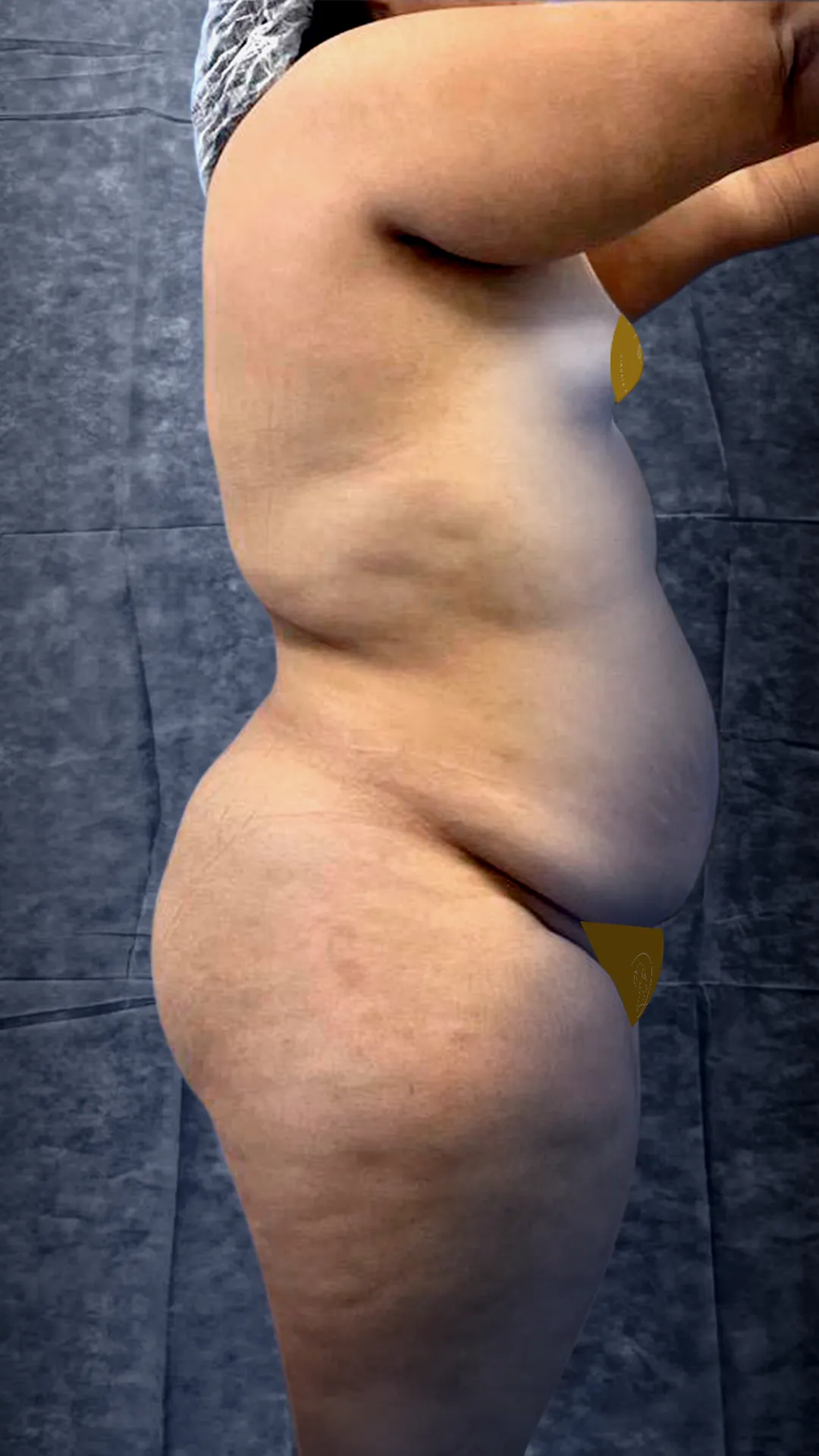 Abdomen: antes