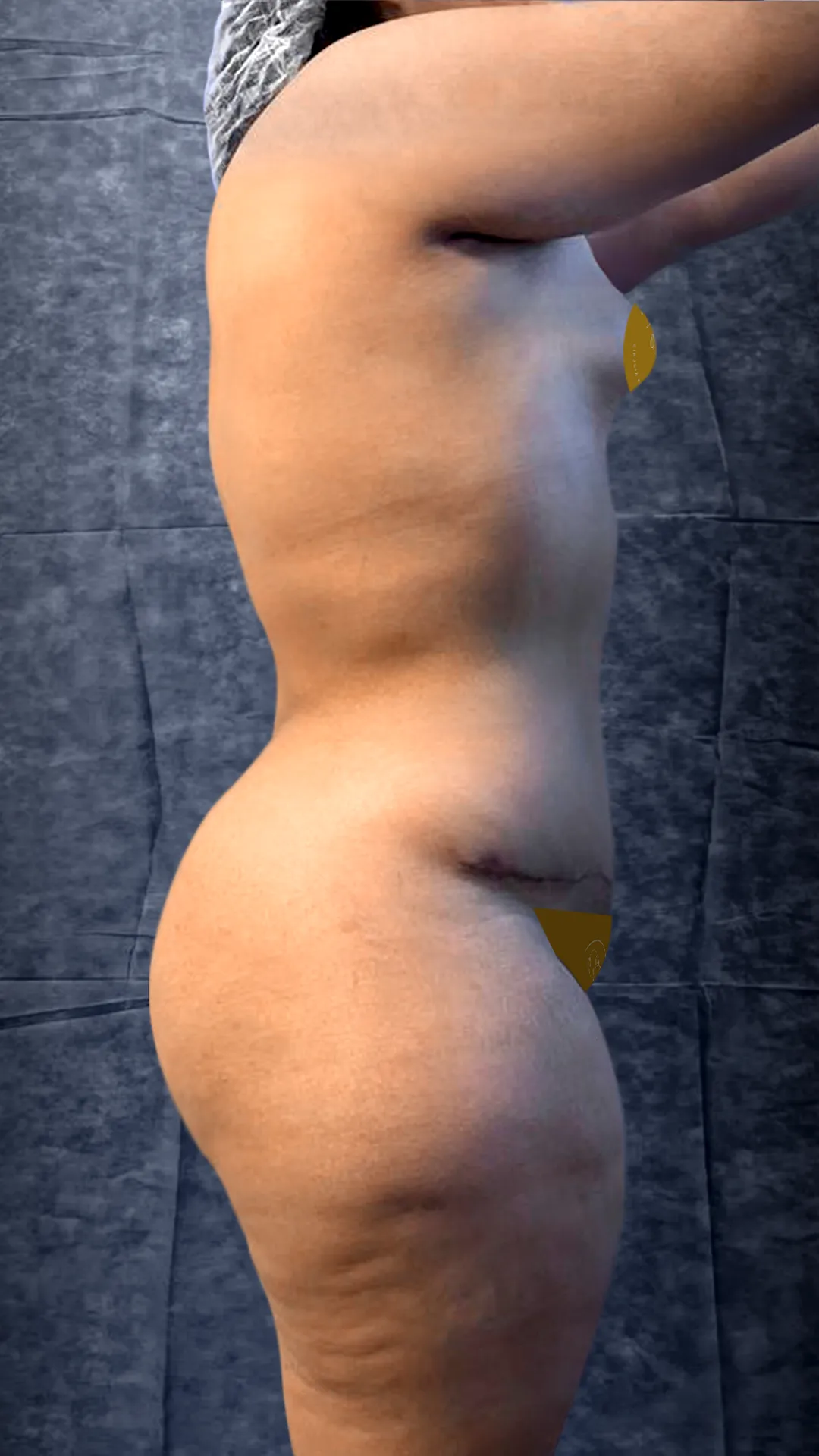 Abdomen: después